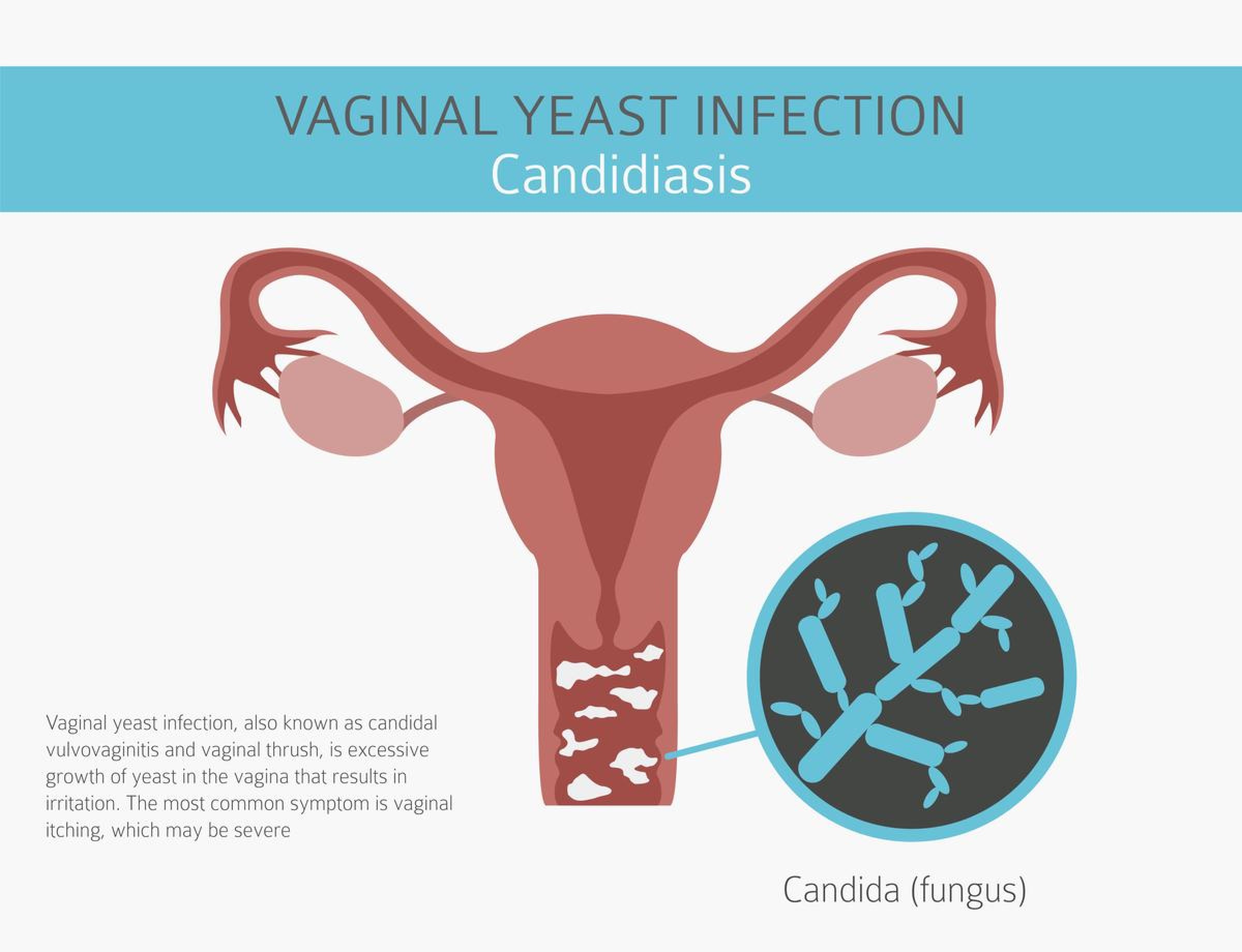 Bacterial vaginosis yeast infections candidiasis