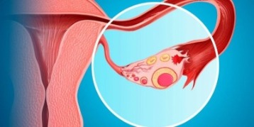 Ovarian Cyst-erhood